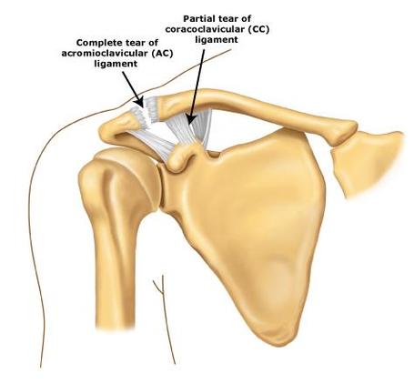 AC joint injury